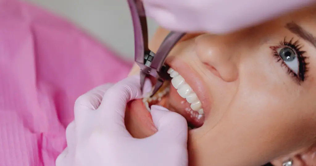 how Invisalign attachments work
