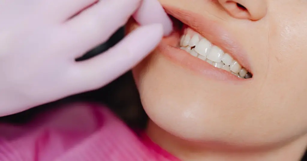 how Invisalign attachments work